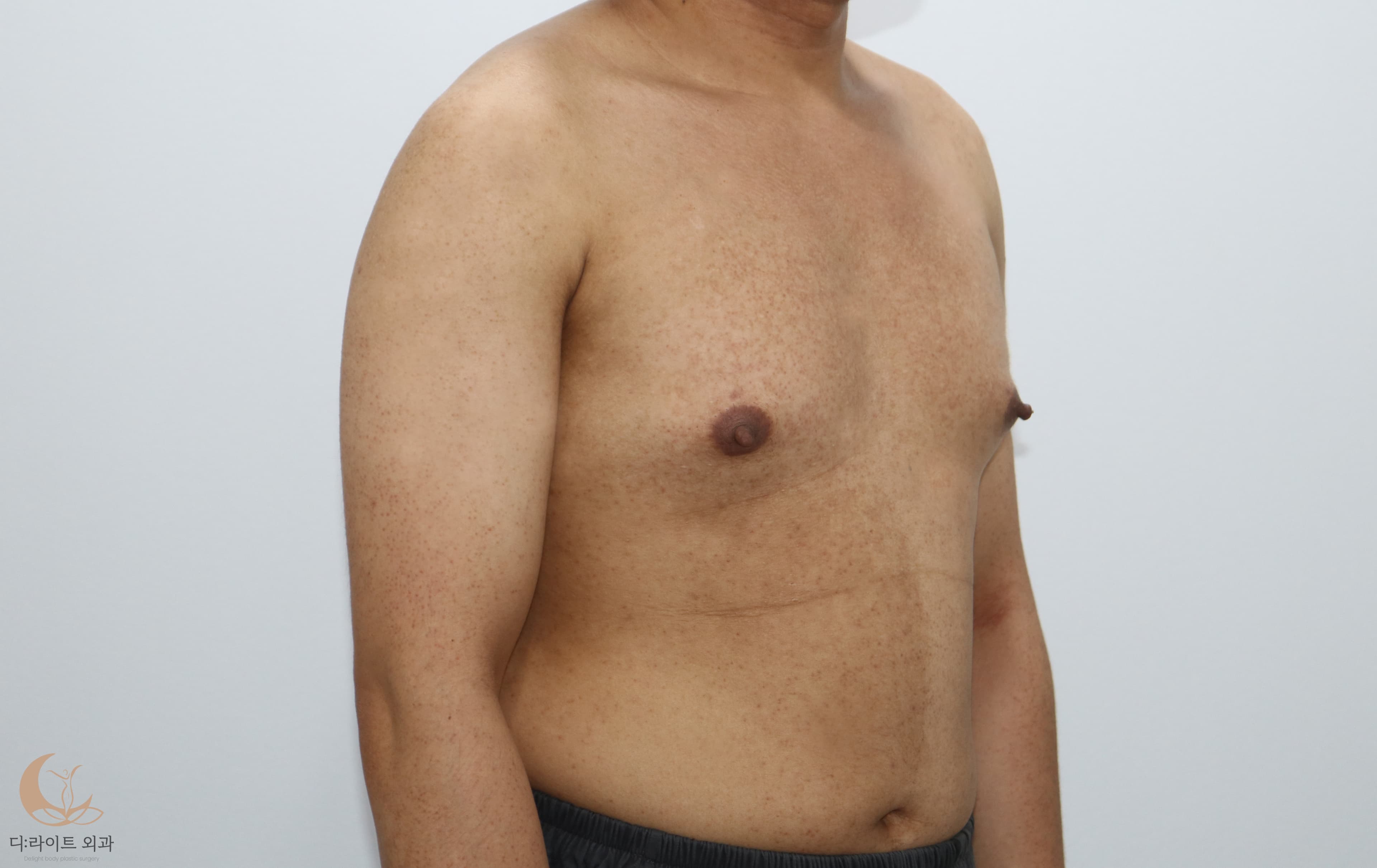 여유증
