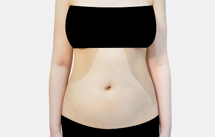 VASER Liposuction before — abdomen · case 2, De:light Gangnam