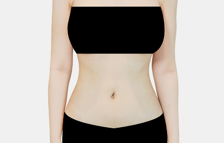VASER Liposuction after — abdomen · case 2, De:light Gangnam