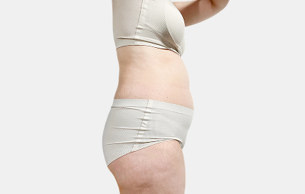 VASER Liposuction before — abdomen · case 3, De:light Gangnam