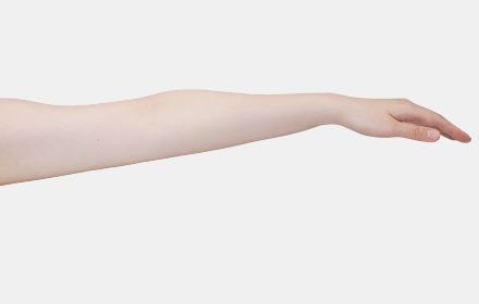 Arm liposuction before — arm extended, De:light Gangnam