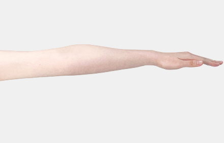 Arm liposuction after — arm extended, De:light Gangnam