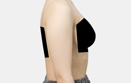 Arm liposuction before — side view, De:light Gangnam