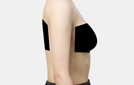 Arm liposuction after — side view, De:light Gangnam