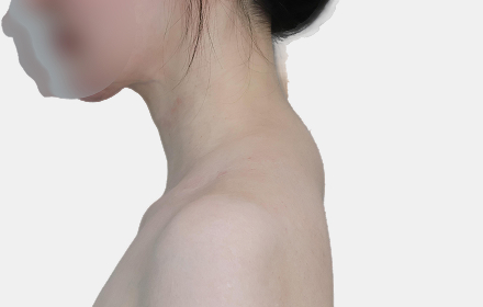 Back Liposuction before — upper back · case 1, De:light Gangnam