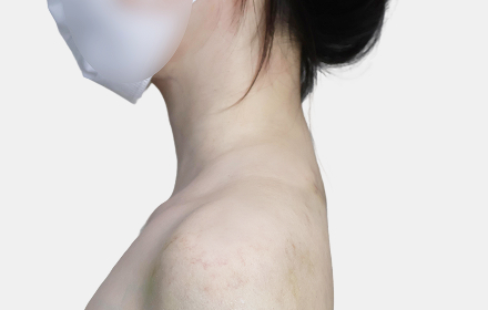 Back Liposuction after — upper back · case 1, De:light Gangnam