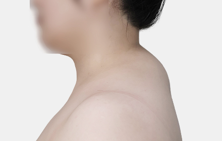 Back Liposuction before — upper back · case 2, De:light Gangnam