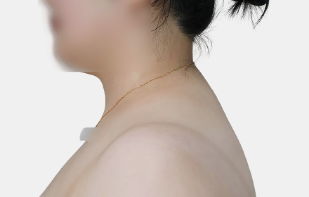 Back Liposuction after — upper back · case 2, De:light Gangnam