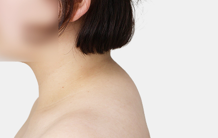 Back Liposuction before — upper back · case 3, De:light Gangnam