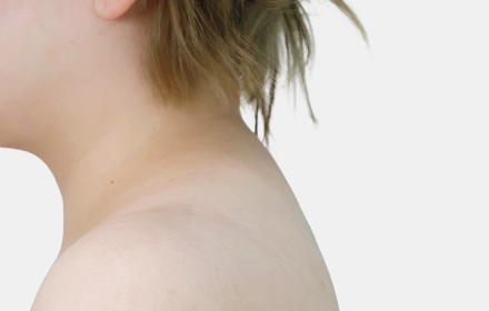 Back Liposuction after — upper back · case 3, De:light Gangnam