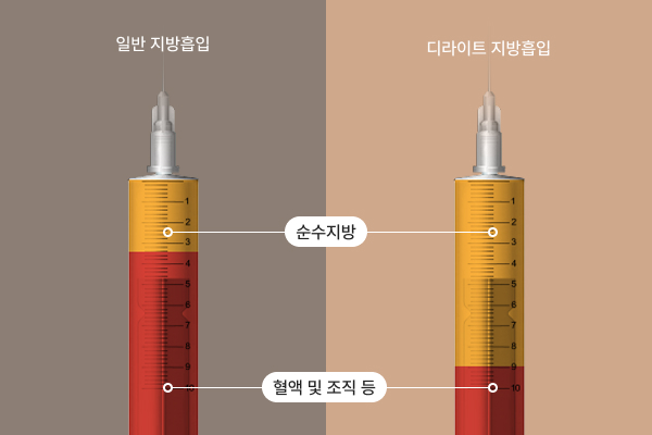 지방흡입시스템