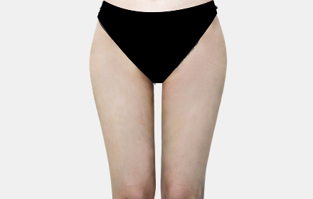 Thigh Liposuction after — case 1, De:light Gangnam