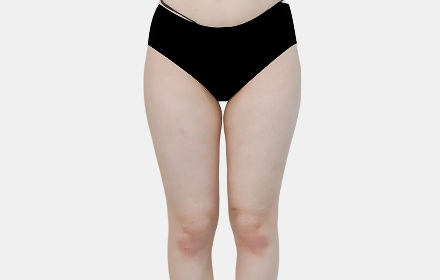 Thigh Liposuction before — case 2, De:light Gangnam
