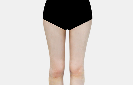Thigh Liposuction after — case 2, De:light Gangnam